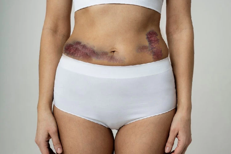 Bruising After Liposuction