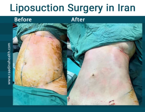 Compression Garments After Liposuction Surgery
