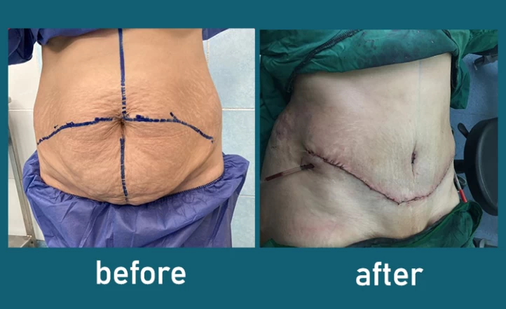 How Vaser Liposuction Minimizes Bruising - Dr. Laguna