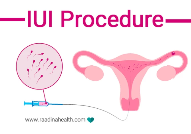 7 IUI Success Symptoms: Confirming Pregnancy After IUI