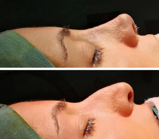 عمليّات تجميل الانف في إيران عمليّات تجميل الانف في إيران