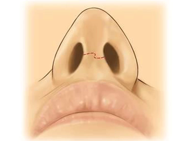الندبات على الأنف بعد جراحة الأنف التجميلية