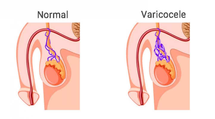 Best Varicocele Treatment  Varicocele Doctor & Hospital