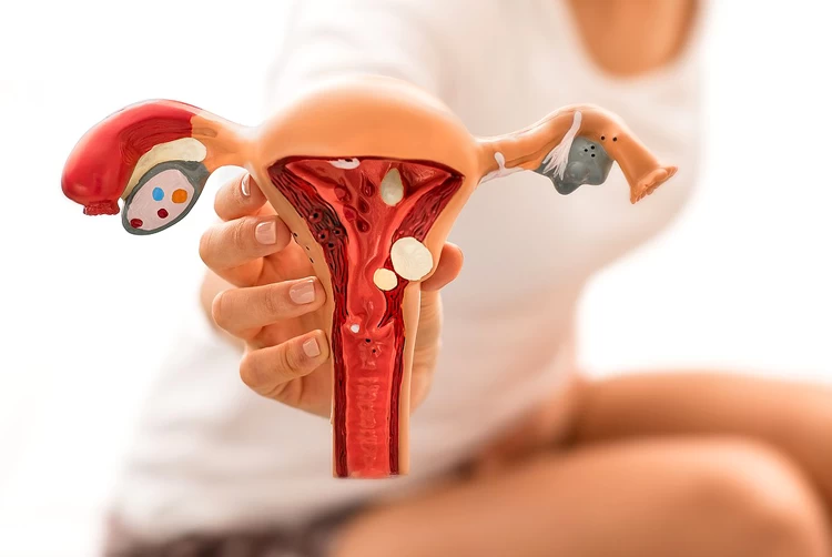 Endometriosis: Symptoms, Stages, and Diagnosis - Raadina Health