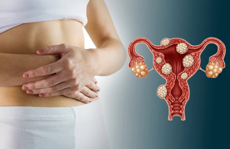 آیا آندومتریوز باعث ناباروری می شود؟