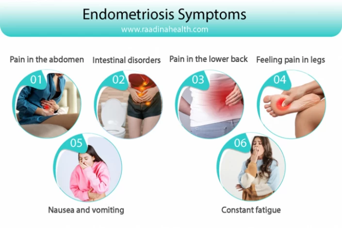 Endometriosis - Causes, Symptoms & Signs