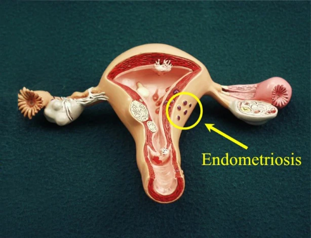 Endometriosis happens when tissue similar to the lining of the uterus  (womb) grows outside of the uterus. Symptoms of endometriosis…