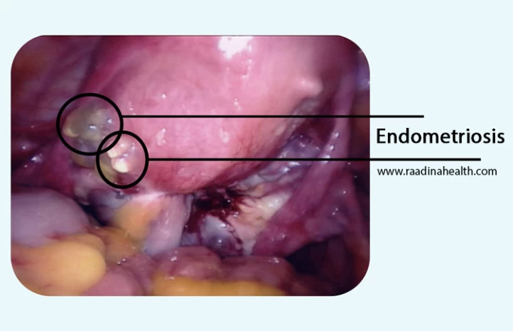 Endometriosis images and severity 