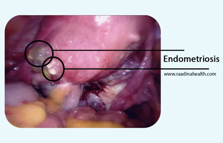 Graphic pic included is this endometriosis clot?