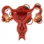 Endometriosis