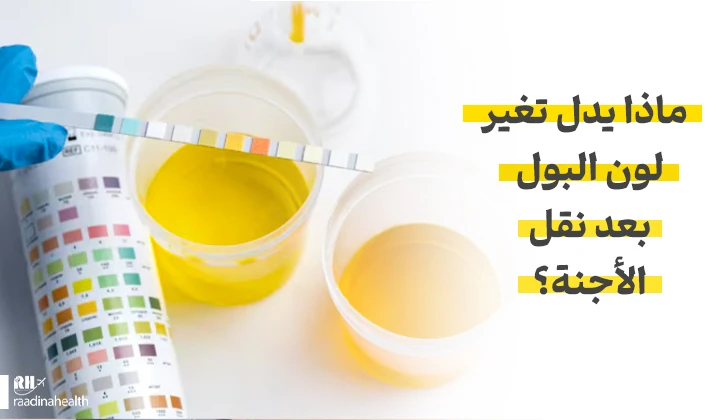 ما هي علامات تغير لون البول بعد نقل الأجنة؟