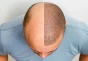 FUE (Follicular Unit Extraction) Hair Transplant