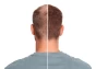 Hair Transplant Success Rates