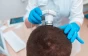 Second Hair Transplant to Add Density