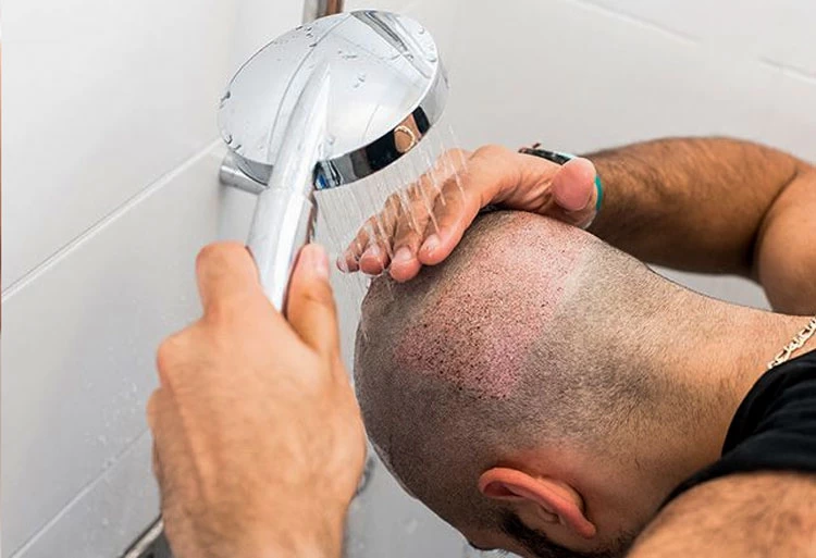 Showering After a Hair Transplant