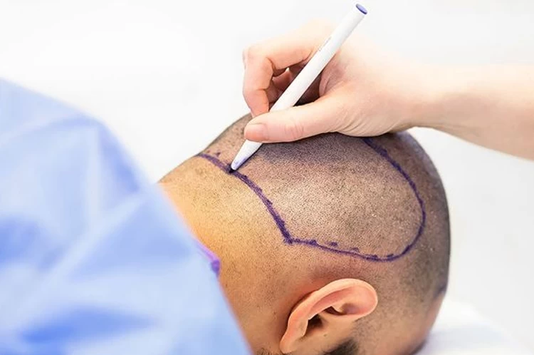 Swelling after Hair Transplant
