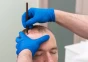 Today, various methods of hair transplant surgery are practiced.