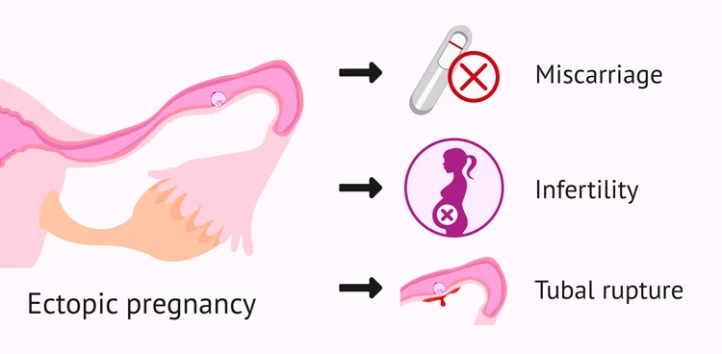 Ectopic Pregnancy Who Are at the Risk of Ectopic Pregnancy?