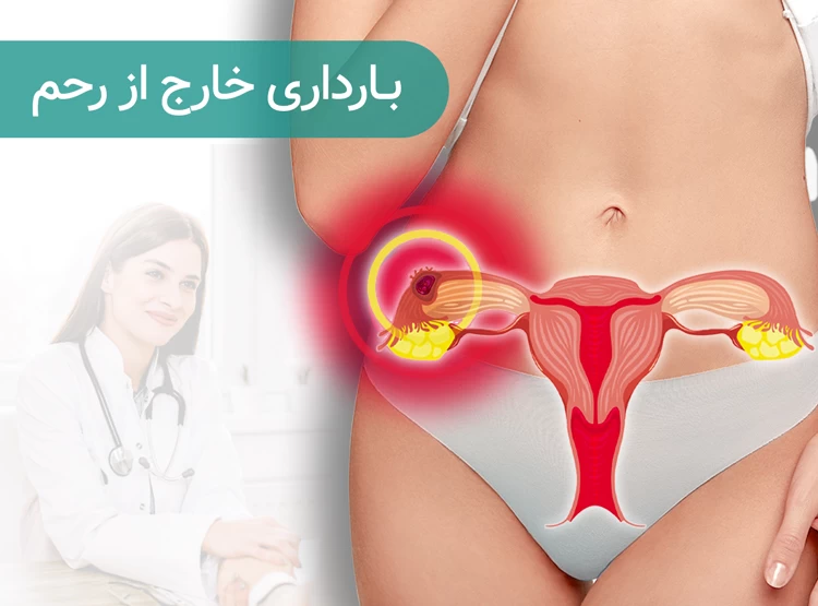 حاملگی خارج رحمی