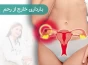 حاملگی خارج رحمی