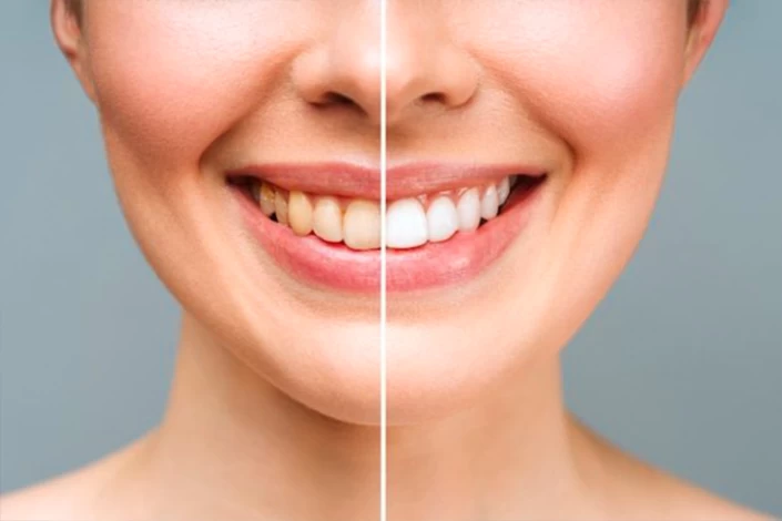 Hollywood Smile Hollywood Smile