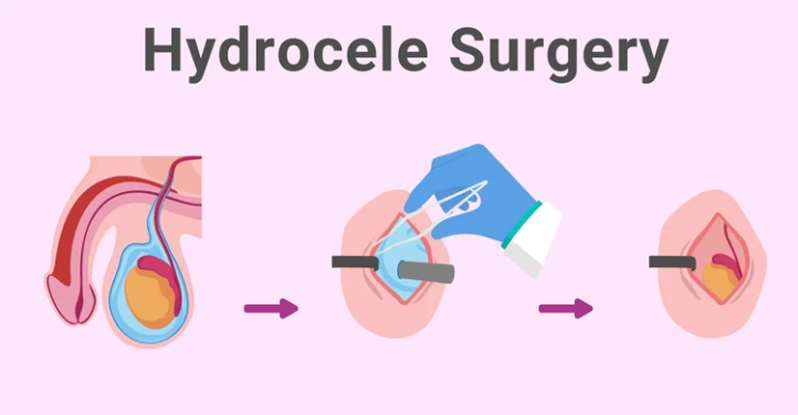 Hydrocele Repair Procedure Complications Raadina Health