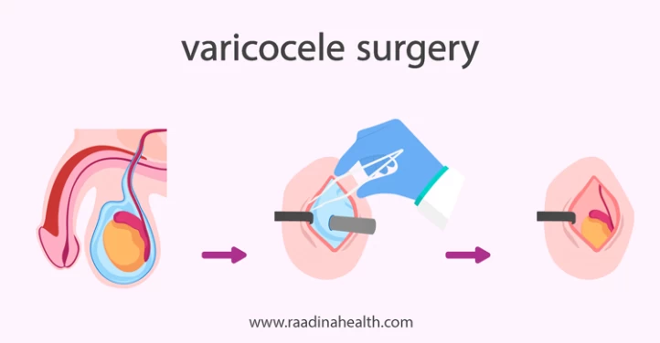 Hydrocele Surgery Types and Procedure Hydrocele Surgery Types and Procedure