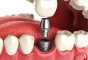 Dental Implant Procedure Dental Implant Procedure