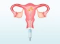 Positive Signs After Embryo Transfer