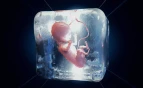 frozen embryo transfer