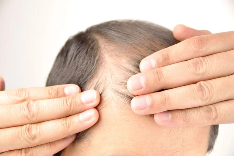 كافة اسباب تساقط الشعر وطرق علاجه