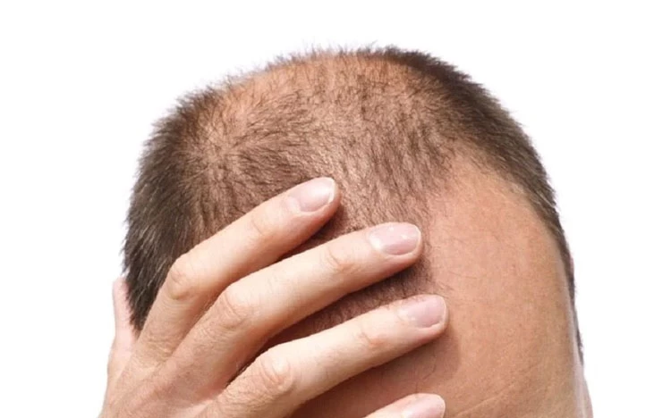 نحوه درمان ریزش مو بعد از کاشت موی SUT کاشت مو به روش SUT