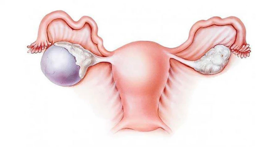 Symptoms of a ruptured ovarian cyst