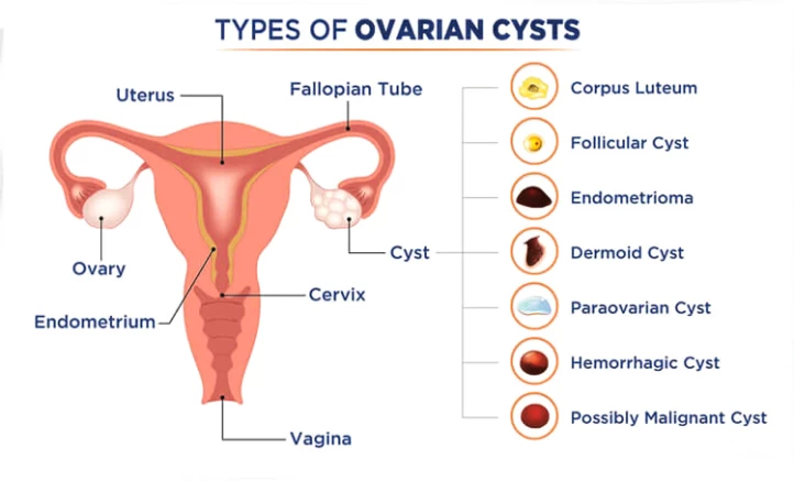 Types Of Ovarian Cysts