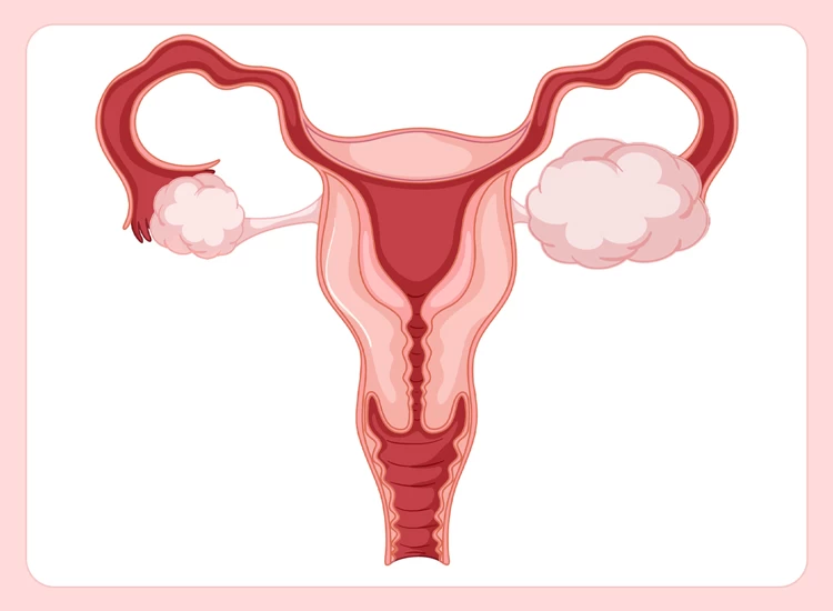 What Happens When an Ovarian Cyst Ruptures?