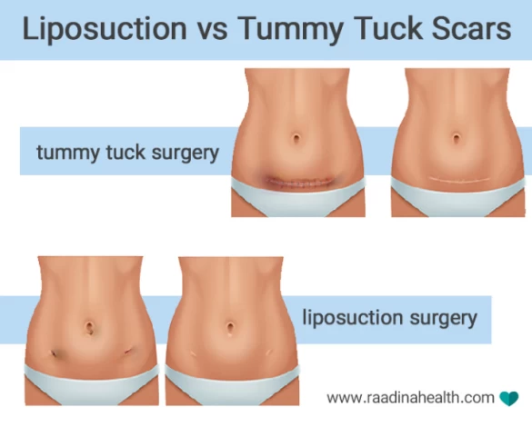 Liposuction vs. Tummy Tuck: Results, Pictures, Recovery, and Cost