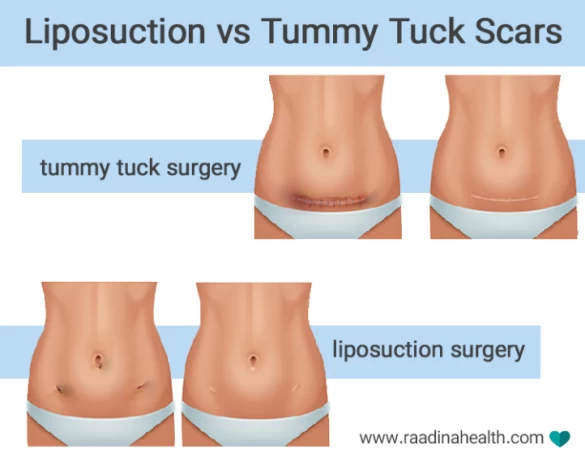 Liposuction or Tummy Tuck: Which One Is Better? - Raadina Health