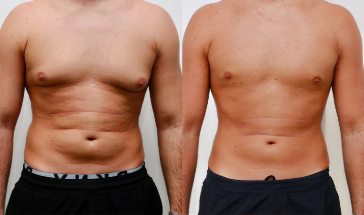 Gynecomastia India on X: The goal of #gynecomastia treatment is to reduce breast  size in men who are embarrassed by overly large breasts. Reduction methods  include #liposuction, cutting out excess glandular tissue