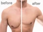 التثدي (Gynecomastia) هي حالة صحية تشير إلى تضخم أنسجة الثدي عند الرجال ومن الممكن أن تحدث في أي عمر.
