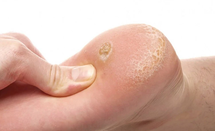 علل ظاهر شدن میخچه میخچه پا