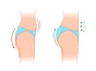 Procedure & Risks of Brazilian Butt Lift Surgery