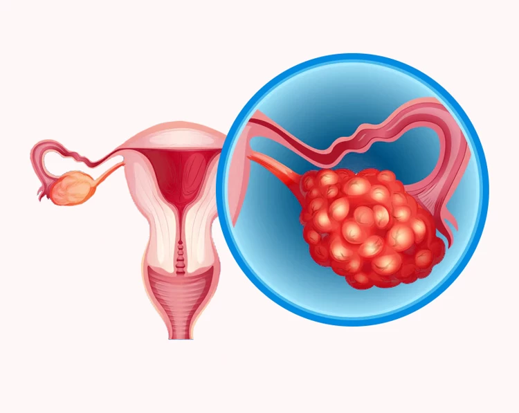 آیا تنبلی تخمدان باعث ناباروری می شود؟