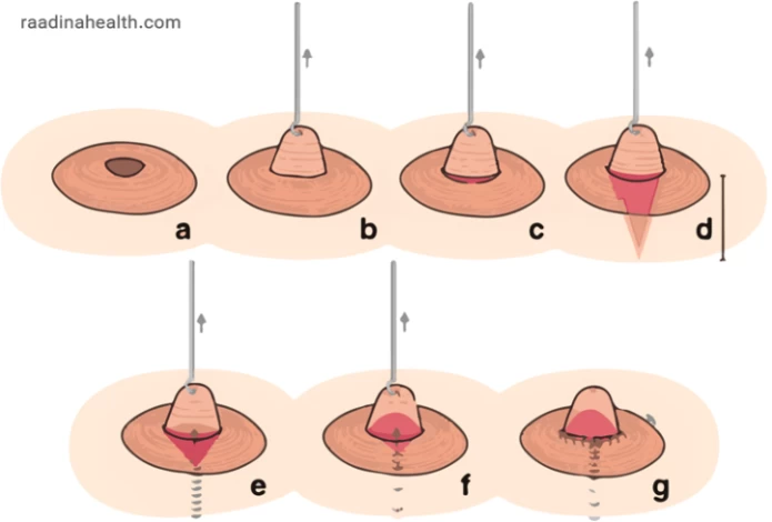 Inverted Nipple Correction: Procedures & Recovery - Raadina Health