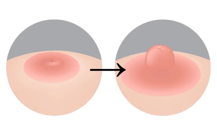 How to Treat an Inverted Nipple Without Surgery