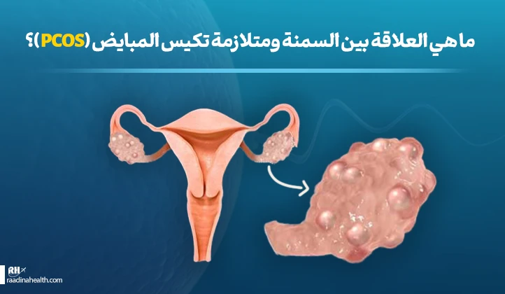 چاقی و تخمدان پلی کیستیک PCOS چه ارتباطی دارند؟