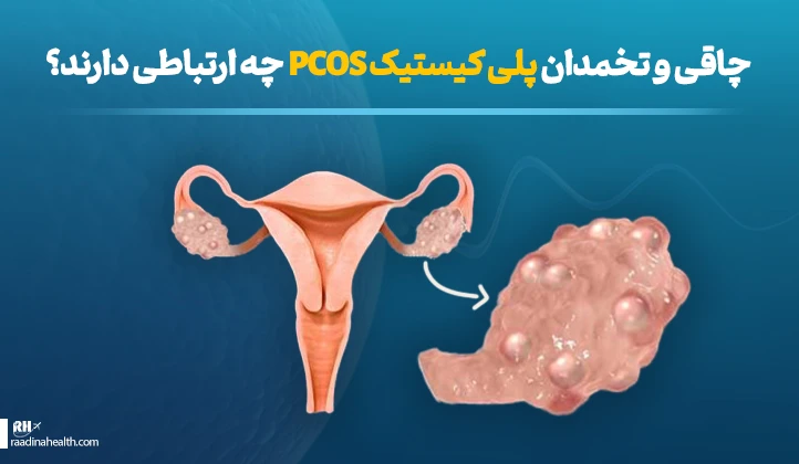 ارتباط چاقی با تخمدان پلی کیستیک PCOS