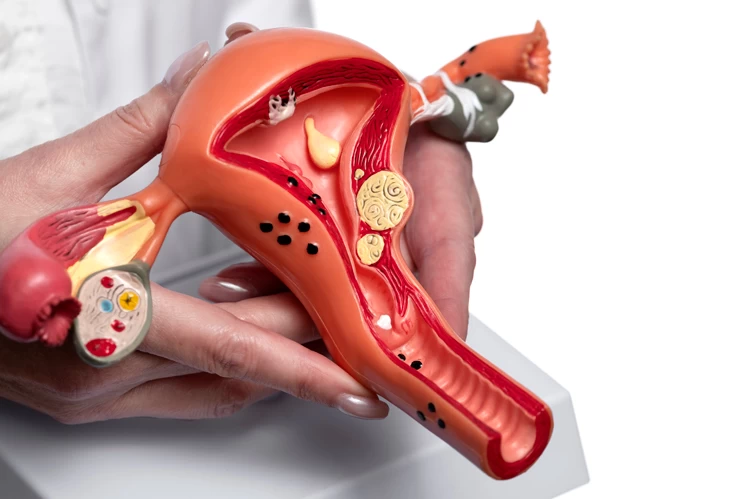 پیچ خوردگی نخمدان چیست؟