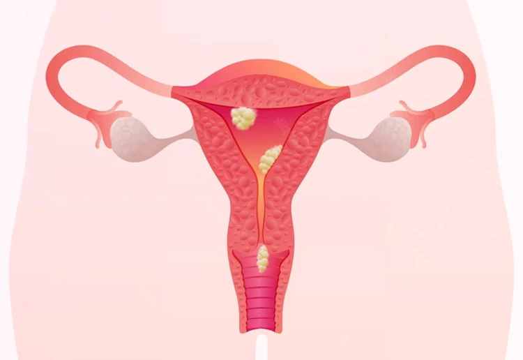 Treatment for Endometriosis to get Pregnant - Raadina Health