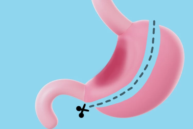 Gastric Sleeve Surgery: What to Expect During and After the Procedure?