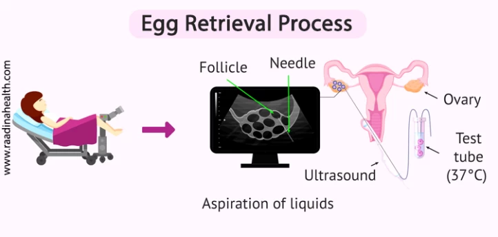 What to Do After Egg Retrieval What to Avoid Raadina Health